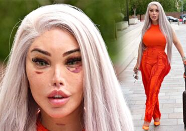 Tohle není pohled pro každého: Jessica Alves ukázala modřiny po plastice a zapomněla si podprsenku