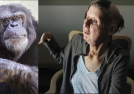 Nepomohla ani kudla v zádech: Jak nyní vypadá žena, které šimpanz utrhl ruce a téměř snědl obličej?