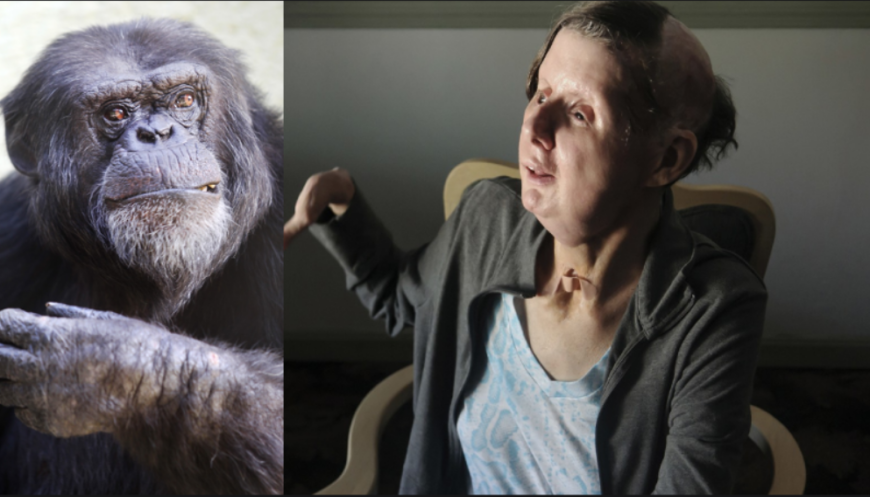 Nepomohla ani kudla v zádech: Jak nyní vypadá žena, které šimpanz utrhl ruce a téměř snědl obličej?